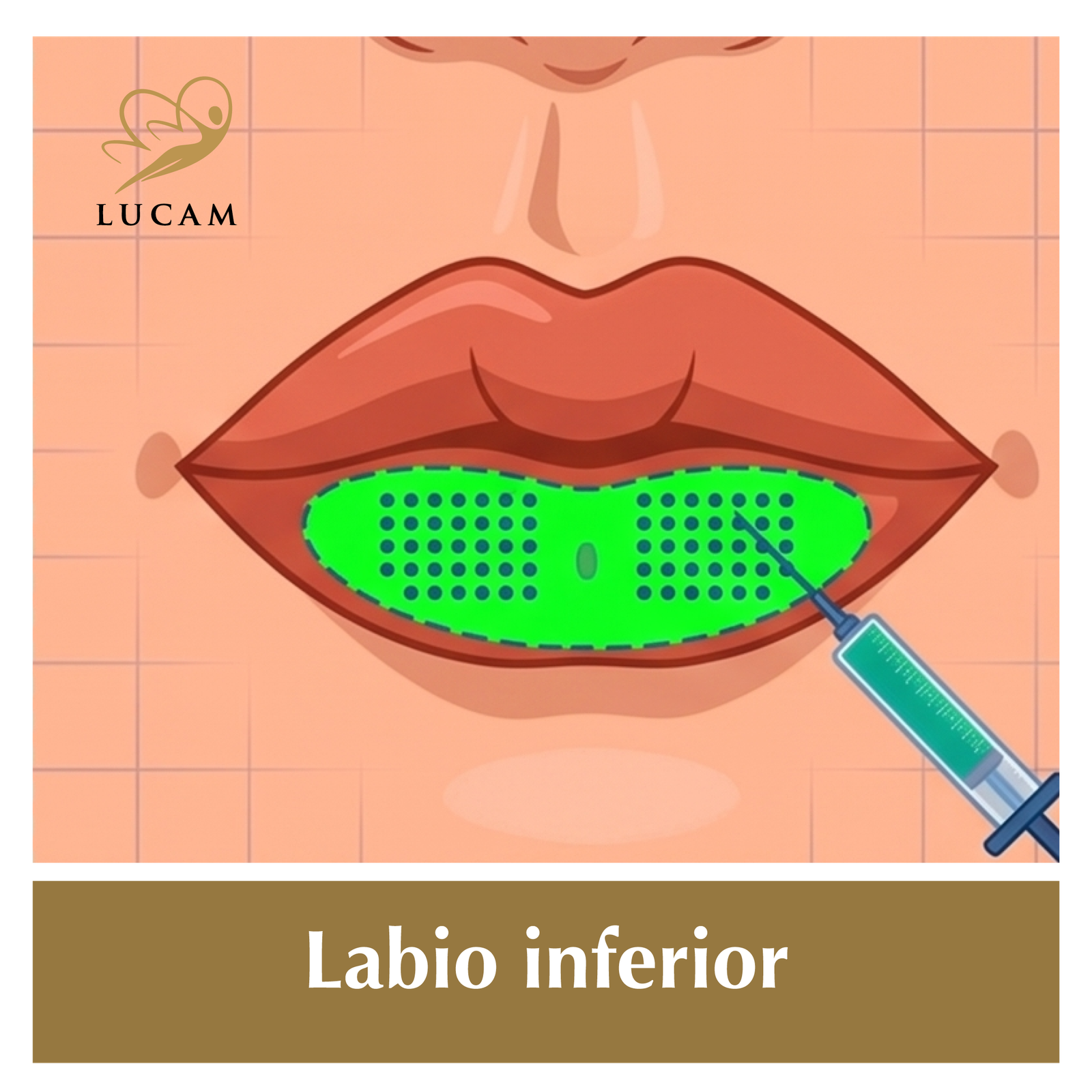 Aumento labios-en-grinon10