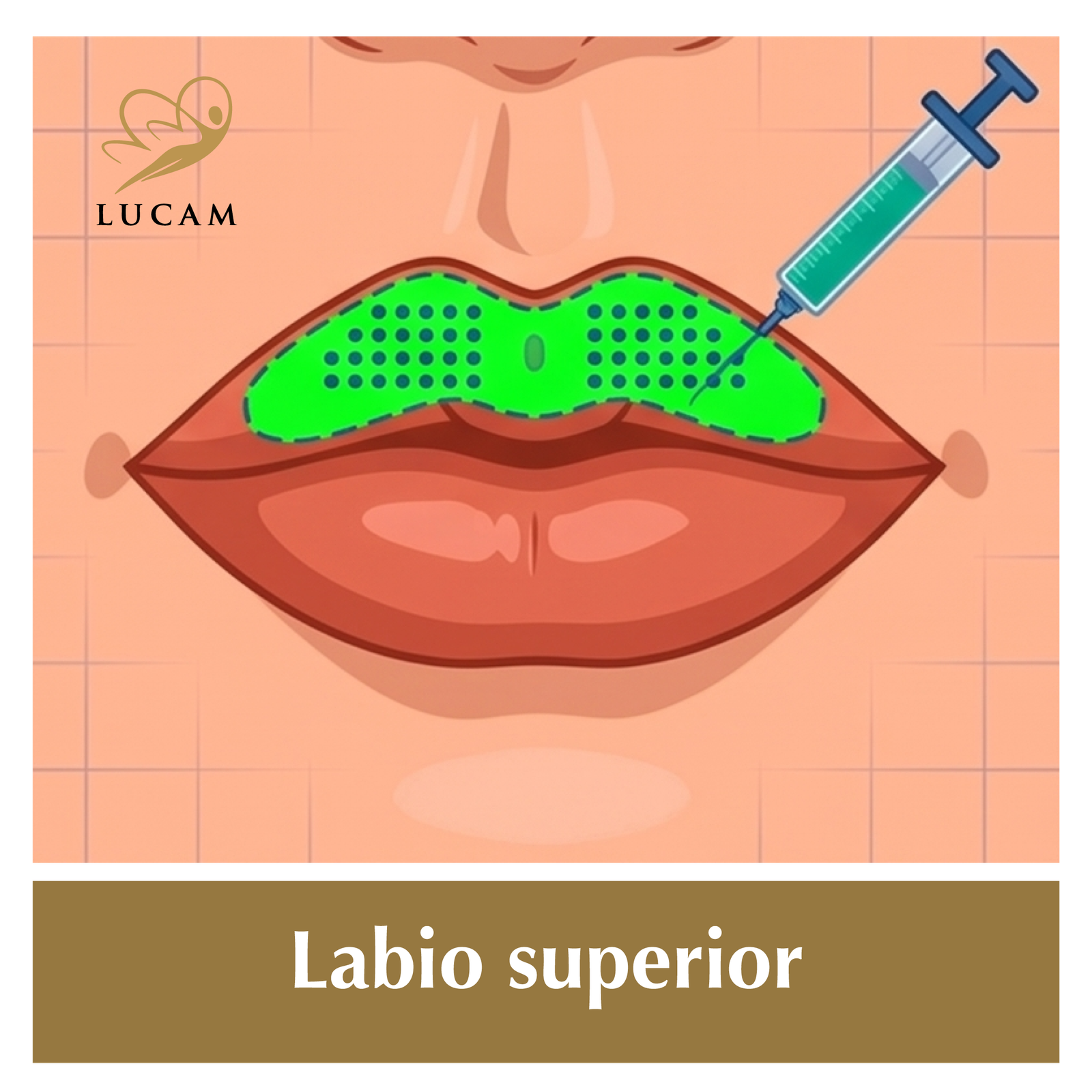 Aumento labios-en-grinon11