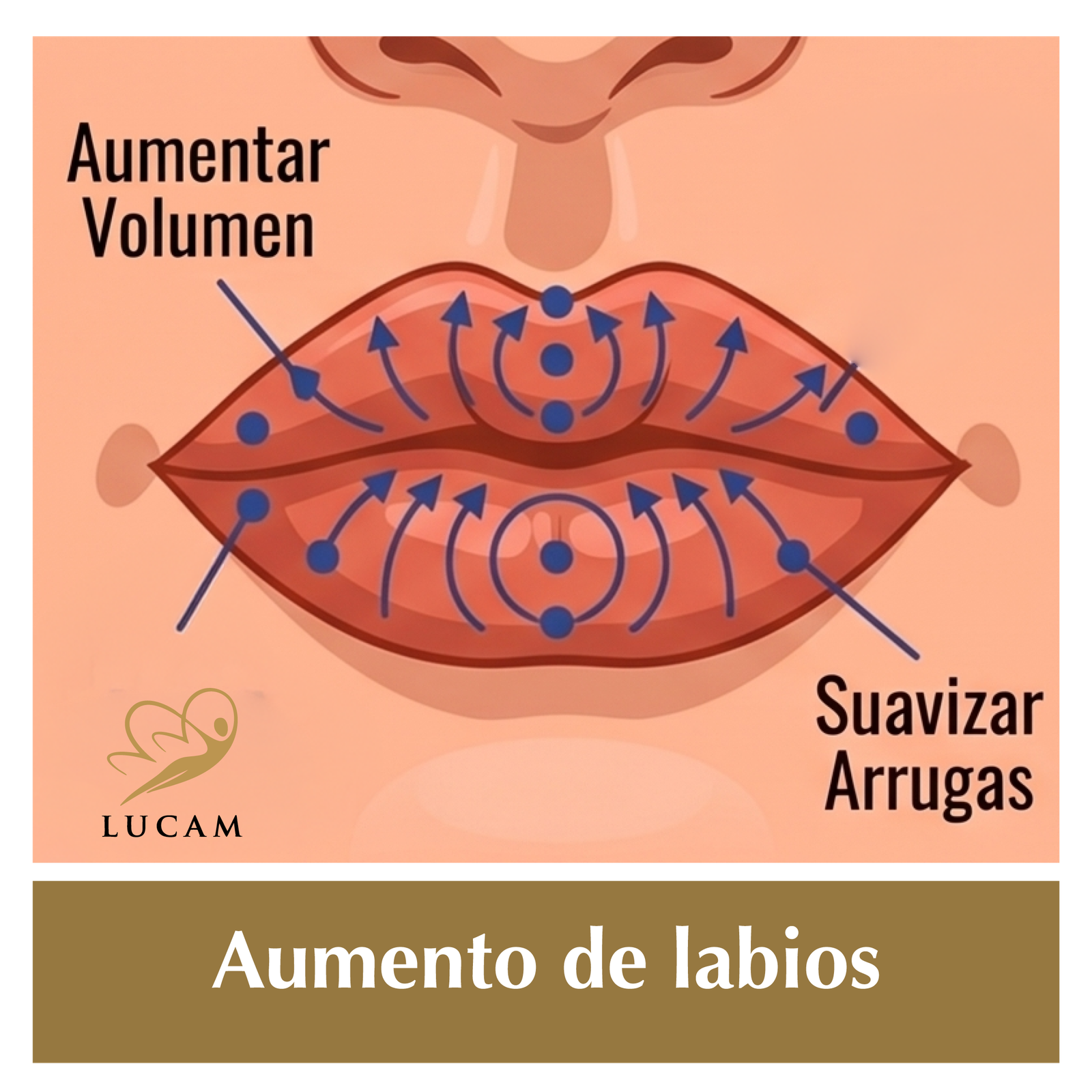Aumento labios-en-grinon2